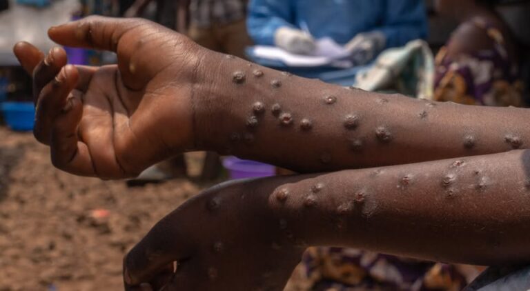 Mpox Cases Reach 314 Nationwide; Ministry Of Health Issues Urgent Alerts